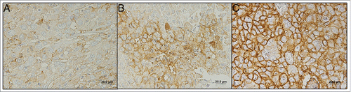 Figure 3. Photomicrographs representative of weak (A), moderate (B) and strong (C) scores. MCT1 immunohistochemical staining in melanoma samples is shown.