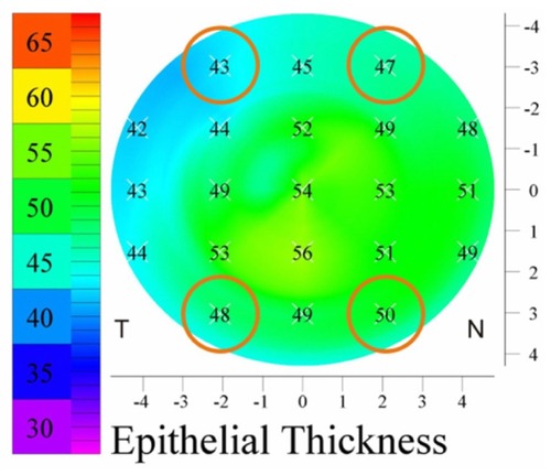 Figure 5 The four transitional zone points used to calculate peripheral epithelium thickness on each eye.