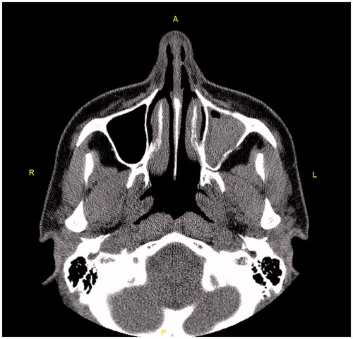 Figure 8. The axial section shows opacification and atelectasis of the left maxillary sinus.