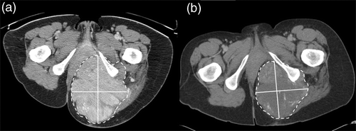 Figure 1. A representative CT image of a tumor mass at the left gluteal region from a patient with a leiomyosarcoma (a) before and (b) after EIA/RHT therapy (the radiological examination before therapy was performed in prone position). Solid lines were maximum diameter and perpendicular maximum diameter of the lesion for the determination of the tumor size according to RECIST and WHO criteria. Dashed lines were delineation of the lesion for the determination of the tumor size according to volumetric criteria. The response to therapy was assessed as stable disease using each radiological response criterion. The pathohistological examination yielded no response.