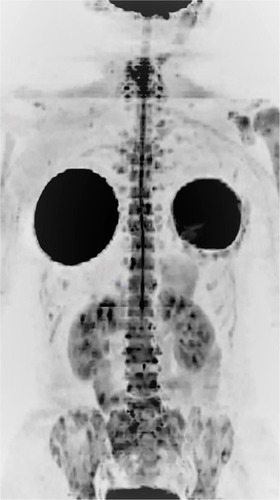 Figure 1 A 39-year-old female patient with a diagnosis of breast cancer, as well as bilateral mastectomy and breast prostheses implantation, undergoing chemotherapy. Notes: Whole-body MR with diffusion-weighted images (b800) with three-dimensional reformatted MIP in inverted grayscale in the coronal plane: multiple bone metastases in the ribs, spine, sacrum, pelvis, both scapulas and humeri. The mammary implants are also observed. The findings on bone scintigraphy were similar.Abbreviations: MIP, maximum intensity projection; MR, magnetic resonance.