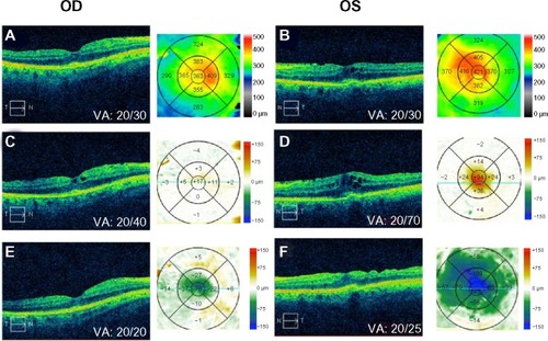 Figure 1 Baseline OCT and contour maps of right (A) and left (B) eyes at 1 week post-PGE1 injection; OCT with difference map of right (C) and left (D) eyes; and posttreatment OCT with difference maps of right (E) and left (F) eyes.