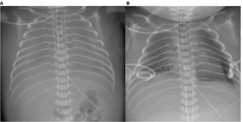Figure 3 Bilateral CC, before (A) and after (B) intercostal drain insertion.