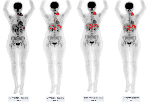Figure 1. MIP (maximal intensity projection) image of the four segmentation techniques, from left to right: fixed 41% threshold (V41%), fixed absolute SUV threshold of 2.5 (V2.5), SUVmax(lesion)/SUVmean liver > 1.5 (Vliver) and adaptive method (AM). Corresponding MTV (metabolic tumor volumes) at baseline are shown beneath each MIP image. The areas highlighted in red in the figures indicate the contours of the malignant lesions delineated by each segmentation technique. Reproduced from Lopci et al. [Citation10] under the Creative Commons Attribution (CC BY) license (https://creativecommons.org/licenses/by/4.0/).