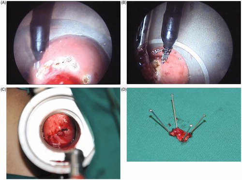 Figure 1. The surgical procedures of TEM (A) Mark (The boundary line of the resection was burned with an ultrasound knife.) (B) Resection (Resect the intestinal wall full-thickness and ensure the integrity of specimen with 1 cm of the incisal margin.) (C) Suture (Continuous or interrupted full-thickness suture was carried out with 3–0 absorbable sutures.) (D) Specimen (The resected sample was submitted for pathological examination after the fixation of the margin with a pin.).