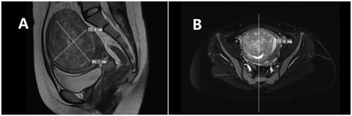 Figure 1. Pelvic magnetic resonance image of a type II–Ⅵ uterine fibroids. (A) Sagittal view of the T2-weighted image reveals the fibroid located in the posterior wall and fundus of the uterus, extending more than 50% into the muscular layer. (B) Transverse images demonstrate the fibroid on the posterior wall protruding into the uterine cavity, with an anteroposterior diameter of 8 cm.