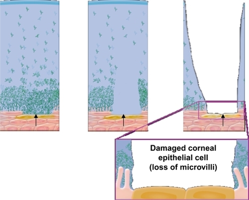 Figure 3 Progressive damage of corneal surface cells (lost microvilli) due to unhealthy tear film