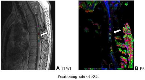 Figure 2 Positioning site of ROI. (A) T1WI image; (B) FA image. TIWI showed FA was a DTI scalar, representing axon integrity and closely related to fiber integrity.
