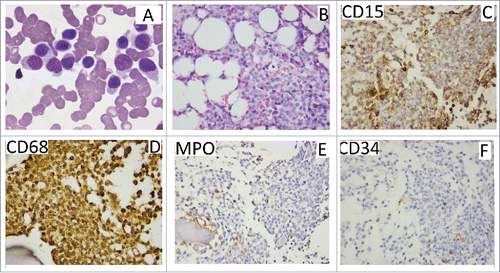 Figure 1. Histopathology of bone marrow. (A) the Wright-Giemsa stain in bone marrow smear, the characteristic of monocytes (folded nuclei and delicate nuclear chromatin) is obvious. (B) a bone marrow biopsy specimen, the granulocytic component is most obvious in the biopsy specimen. (C,D) positive staining for CD15 and CD68 E, F: negativity for MPO and CD34.
