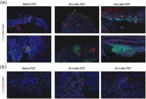 Figure 5. ALA-PDT suppresses tumor growth by altering the TLS-mediated tumor microenvironment in cSCC patients. (a) Tumor tissues from cSCC patients were subjected to immunohistochemistry staining. Tumor tissues (48 h after ALA-PDT) were randomly selected from 2 sites. The yellow circles show TLSs, the yellow arrows indicate the enlarged area in the image below. (b) Tumor tissues (24 h after ALA-PDT) were randomly selected from 2 sites. The yellow circles show TLSs. The scale bar is 200 μm (white) and 50 μm (yellow).