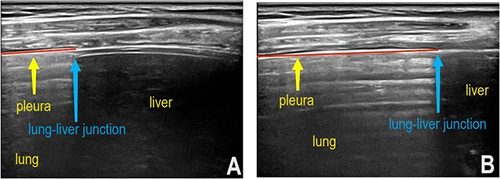 Figure 2 Pleural sliding displacement (PSD) measurement method. (A) The distance between the lung–liver junction and the left edge of the acoustic window of the ultrasound instrument was measured along the pleural line at the end of expiration. (B) The distance between the lung–liver junction and the left edge of the acoustic window of the ultrasound instrument was measured along the pleural line at the end of inspiration. The difference between the two values is the PSD.