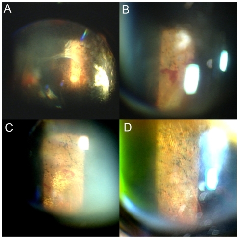 Figure 3 The right eye of the same patient. A) and B) A fundus photograph using a slit-lamp examination of 5 months later shows that the posterior vitreous detachment further progressed beyond the arcade area A), accompanying retinal hemorrhage around the detached retina B). C) A fundus photograph using a slit-lamp examination of 8 months later shows that the retina is reattached, and hard exudates are observed in the nasal periphery. D) A fundus photograph using a slit-lamp examination of 12 months later shows that those hard exudates are resolved.