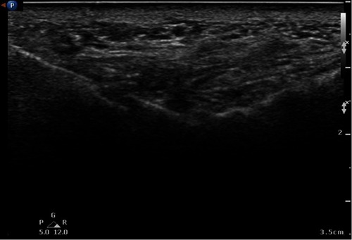 Figure 7 Photograph during the infraorbital nerve radiofrequency cautery.