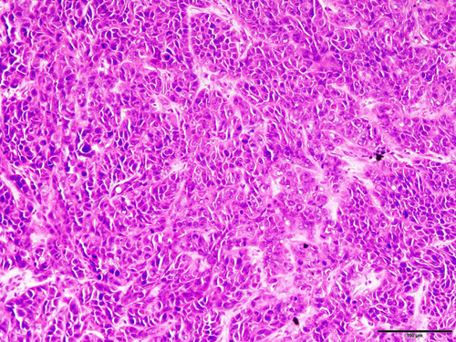 Figure 1 Pathological section of tumor formed 3 weeks after the inoculation of Tca8113 cells into the cheek of nude mice (hematoxylin and eosin stain, ×200).