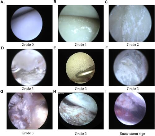 Figure 1 Arthroscopy showed the monosodium urate crystal deposition or tophi in joints. (A) No obvious crystal deposition. (B) Distribution of crystals is scattered. (C) Multiple crystal depositions in < 50% of the affected articular cartilage and soft tissues. (D–H) Multiple crystal depositions in > 50% of the articular cartilage and soft tissues, crystal erosion of the articular cartilage, or large tophi. (I) The snow storm sign.