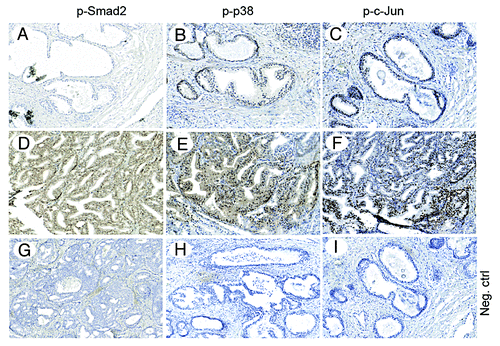 Figure 12. Immunohistochemical detection of p-Smad2, p-p38 and p-c-Jun in prostate cancer tissues. Serial, paraffin-embedded sections of normal prostate and prostate cancer tissues were immunostained with p-Smad2, p-p38 and p-JunSer63 antibodies and biotin-streptavidin amplified peroxidase immunodetection. 3,3′-Diaminobenzidine was used as chromogen and Mayer hematoxylin as counterstain. (A–C), representative images, from normal or highly differentiated prostate cancer tissues. (D–F), representative images from low differentiated prostate cancer tissues. (G–I), Negative control for immunohistochemical stainings, where the primary antibodies, respectively, was omitted. Representative images from cancer tissues (Scale bar 200 μm).