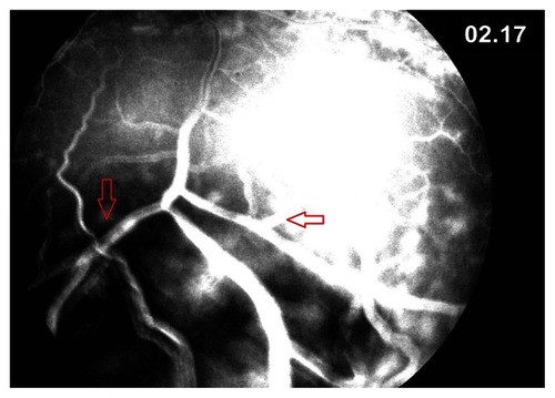 Figure 4 Late frame of fluorescein angiography.