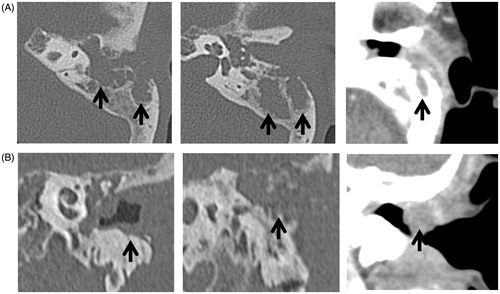 Figure 1. (A) Axial computed tomography scan of the left petrous temporal bone (B) Coronal computed tomography scan of the left petrous temporal bone showing osteonecrosis of the wall of the external auditory canal together with invasion into the mastoid bone (arrow).