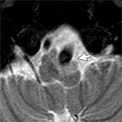 Figure 2 MRI of the brain. Thin slice axial T2-weighted with fat suppression shows dolichoectatic left vertebral artery exerting a pressure effect to the left medulla with a hypersignal T2 change at left medulla (arrow).