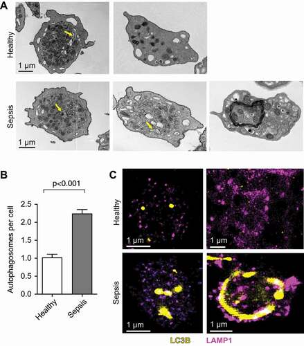 Figure 2. Platelets isolated from septic patient demonstrate increased autophagosomal activity when compared to platelets isolated from healthy individuals. (A) Transmission electron microscopic analysis of healthy platelets (top row) and platelets isolated from septic patients (bottom row, scale bars: 1 µm). Yellow arrows indicate autophagosomes of various content. This figure is representative of n = 5 independent experiments. (B) Bar graph showing the quantitative analysis of autophagosomes being present in healthy versus septic human platelets. The figure represents the analysis of >100 cells per group from n = 5 subjects per group. (C) Images demonstrate healthy platelets (top row) and platelets isolated from septic patients (bottom row) immunostained with an anti-LC3 (yellow), and an anti-LAMP1 (magenta) antibody. Cells were subsequently analyzed using super resolution microscopy. Scale bars: 1 µm. White color expression demonstrates potential colocalization. This figure is representative of n = 4 independent experiments.