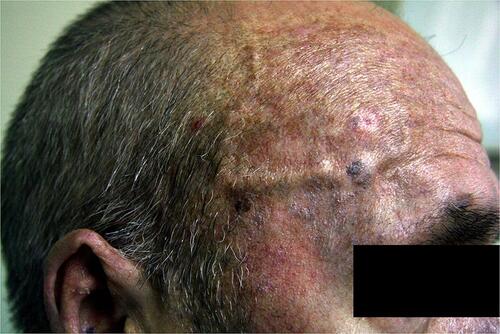 Figure 3 Cutaneous nodules on the surface of the right temporal artery.