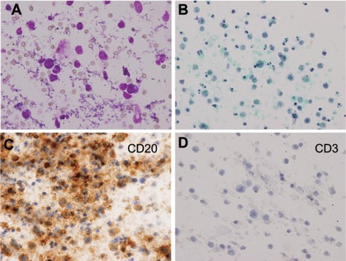 Figure 4 Cytological examination of infusion fluid of Case 2 (400×). (A and B) Atypical lymphocytes with anisonucleosis, aberrant chromatin, and dyskaryosis. (A) Giemsa stain; (B) Papanicolaou stain. (C) Immunocytochemical findings. Lymphoma cells are positive for B-lymphocyte surface antigen (CD20). (D) Immunocytochemical findings. Lymphoma cells are negative for T-lymphocyte antigen (CD3).