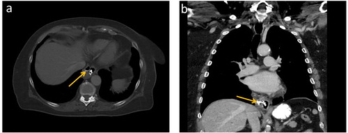 Figure 3. Axial (a) and coronal (b) CT scan of the chest showing evidence of contained esophageal perforation on the right side of the distal esophagus in case IV, including extraluminal air and contrast (arrows).