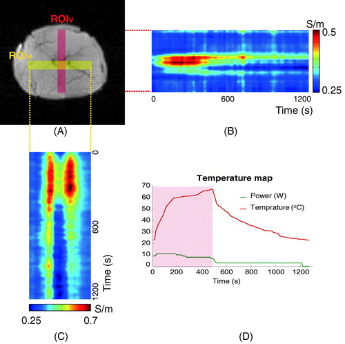 Figure 5. (A) MR magnitude image with two ROIs in the imaging slice where two ablations electrodes were located. (B, C) Spatiotemporal profile maps of the reconstructed conductivity values in two ROIs. (D) Plots of the directly measured tissue temperature and the output power of the RF generator.