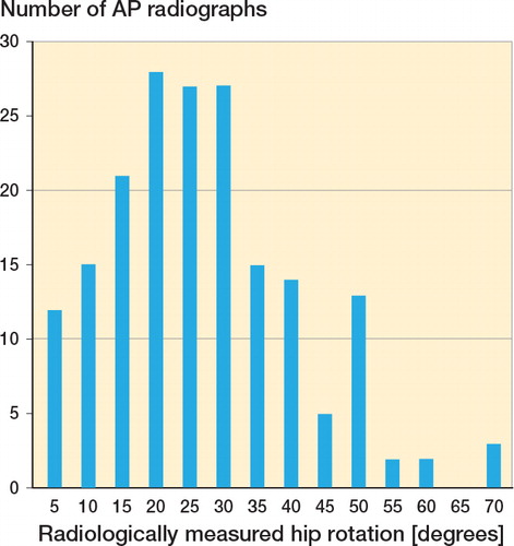 Figure 5. Distribution of radiologically assessed hip rotation in a series of 222 standardized AP radiographs of the hip following proximal femoral fractures.