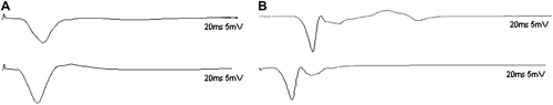 Figure 2. Electrophysiological recordings of the compound muscle action potential of gastrocnemius muscles 4 months after operation. The motor NCV of the tibial nerve in the sham control group was 49.5 ± 4.9 m/s (A) while the value of the distal tibial nerve segment in the experimental group was 27.8 ± 5.3 m/s (B).