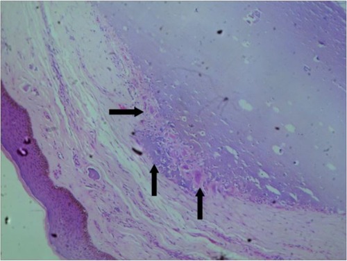 Figure 4 Photomicrograph of a case of idiopathic scrotal calcinosis showing calcified nodule embedded in connective tissue matrix.