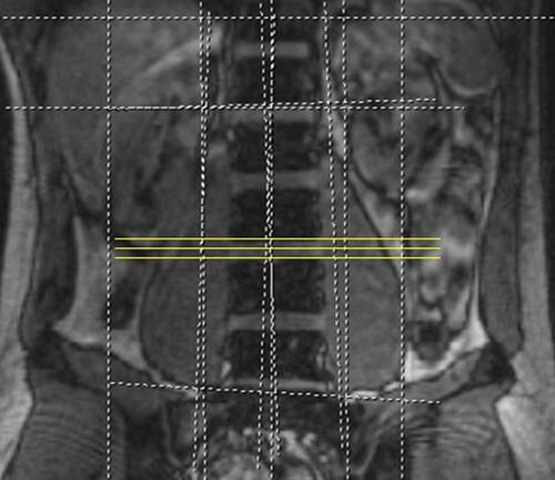 Figure 7 Standard axial views were obtained using 2- to 4-mm cuts through each disc level perpendicular to the standard sagittal cuts at each vertebral junction.