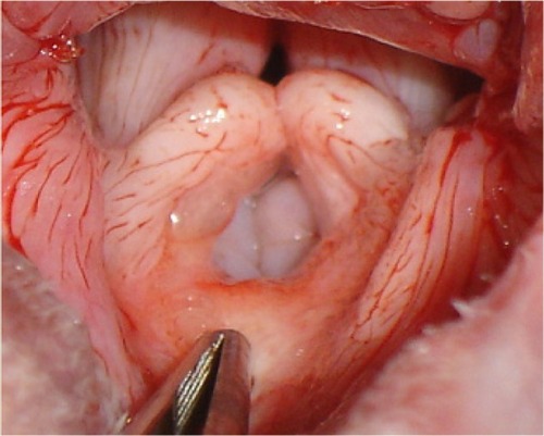 Figure 5 Close-up image of grade II laryngeal collapse.