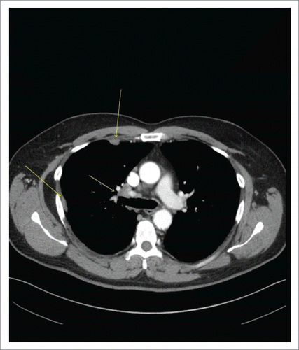 Figure 1. CT Chest with Contrast Demonstrating Right Hilar Disease with Right-sided Pleural Involvement (arrows).