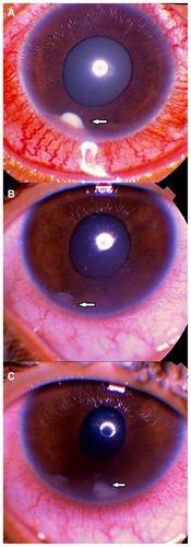 Figure 1 (A) The first presentation of a patient of 11 years old with a pearl-like lesion in the anterior chamber (arrow) at 7 o’clock with ciliary injection and a pearshaped pupil; (B) the presentation of the same patient after 6 weeks of treatment by subconjunctival and topical steroids with a decrease in the size of the lesion (arrow) and of the ciliary injection with some old keratic precipitates; and (C) the appearance of a new lesion in the anterior chamber (arrow) at 6 o’clock in the same patient 1 week after resolution of the first pearl-like lesion.
