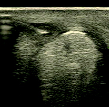 Figure 1. Ultrasound image SDFT lesion during injection – 7.5 MHz.