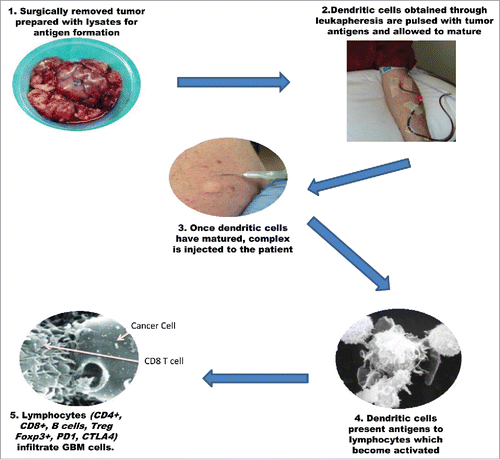 Figure 1. Schematic illustration showing the production, administration and in vivo activation of DC vaccines for the treatment of high grade gliomas.