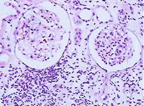 FIGURE 1. Minimal change disease. Entirely normal appearing unremarkable glomeruli on background of nonspecific scanty scarring of the tubulointerstitium and single tubular atrophy. Moderate active inflammatory lymphocytic infiltrate with evidence of tubulitis and periglomerulitis (H&E, × 200).