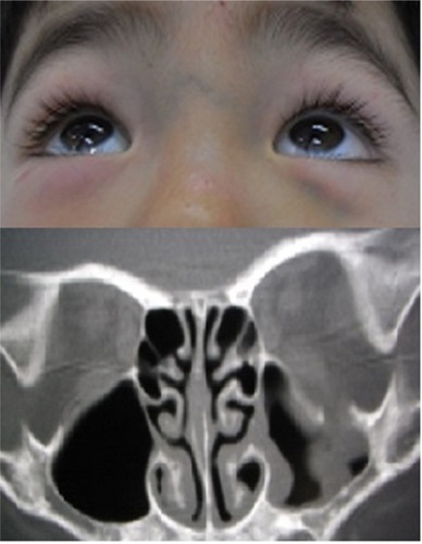 Figure 1 Computed tomography of a boy of 3 years and 3 months of age showing a pure blowout fracture of the left orbital floor with a slight dislocation of orbital contents.