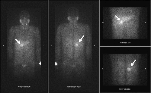 Figure 2. 123Ι-ΜΙBG SPECT/CT scan in a 30-year-old male, showing increased radiotracer uptake in the anatomical location of the right adrenal gland representative of pheochromocytoma (arrows).