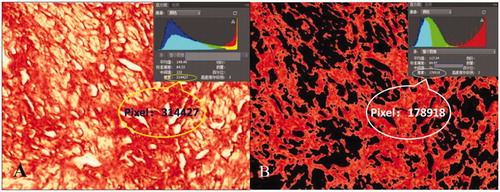 Figure 4. Collagen fiber content on the Sirius red staining image: microscopic magnification, × 400. Photoshop analysis software analyzed the image pixels. (A) pixels of the whole picture and (B) pixels of the red collagen fiber. Collagen fiber content was evaluated as the ratio of the area of red collagen fibers to the total area of image.