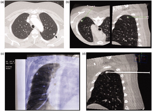 Figure 1. CBCT-guided lung RFA with virtual guidance in a 62-year-old woman. (a) CT image shows an 8-mm nodule (arrow) in the left lower lobe. (b) Virtual-guided planning for a safe needle route (green line) to the target lesion was performed. (c) When CBCT moves automatically until the entry-point view (i.e., vertical alignment from the entry site [red circle] to the target lesion [green circle] with virtual color), spots can be seen on the fluoroscopic image. (d) CBCT was performed after electrode placement to confirm the exact location of the needle tip.