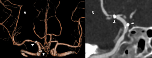 Figure 3 (A and B) Repeat CTA after 2 years revealed stent displacement (white arrowheads show the distal and proximal markers of the stent).