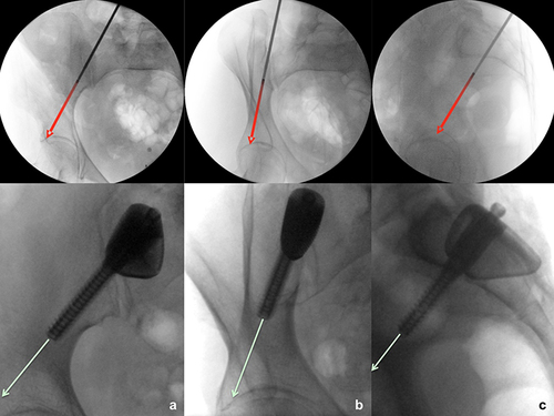 Figure 9 Intraoperative radiographs showing the K-wire in the center of the iliac column (top row) and the iliac screw path (red arrows) in three directions for proper placement of the custom implant (bottom row); (a) a.p., (b) oblique, and (c) lateral views.