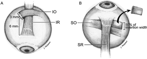 Figure 5. A, Inferior oblique muscle recession, left eye, surgeon’s view. The inferior oblique muscle has been cut near its insertion. Its anterior edge is reattached 6 mm posterior to the lateral border of the inferior rectus muscle insertion. The posterior fibers are reattached at a 45° angle posteriorly and laterally from the anterior insertion. B, Superior oblique tenectomy, right eye, surgeon’s view. The fibers of the superior oblique tendon are disinserted from the anterior border of the insertion to 50% of the width of the insertion. The anterior 50% of the tendon is then removed between the insertion and the lateral border of the superior rectus muscle. IO, inferior oblique muscle; IR, inferior rectus muscle; SO, superior oblique tendon; SR, superior rectus muscle. Reproduced with permission from [Citation104]