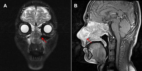 Figure 1 MRI coronal view showed a mass in the nasal cavity (A) and MRI sagittal view showed a heterogeneously enhanced mass (red arrow) at nasal cavity affecting ethmoid sinus, sphenoid sinus and hard palate bone (B).