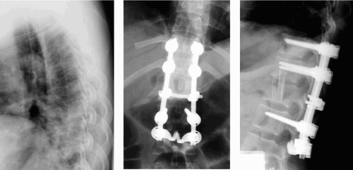 Figure 6. Preoperative and postoperative radiographs taken during hospitalization.