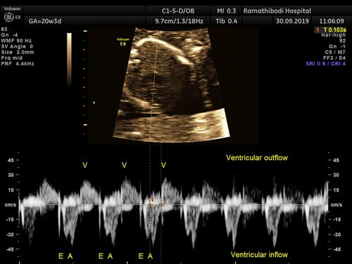 Figure 1 Pulsed wave Doppler image of mitral valve inflow–outflow view obtained from five-chamber view, time between atrial systole of mitral valve and onset of ventricular systole represents mechanical PR interval.