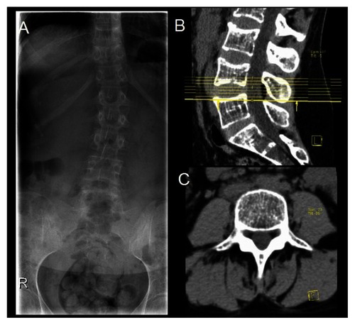 Figure 2 Lumbar spine X-ray (A) and computed tomography scan (B, sagittal view and C, axial view) of the spine showing diffuse low bone density.