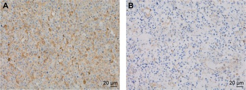 Figure 2 The expression of VEGFR2 in tumor vessels.